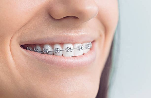 Ceramic Braces vs. Metal Braces