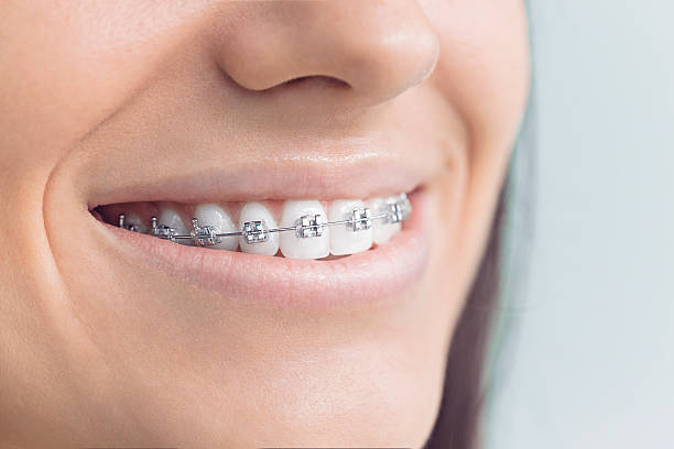 Ceramic Braces vs. Metal Braces