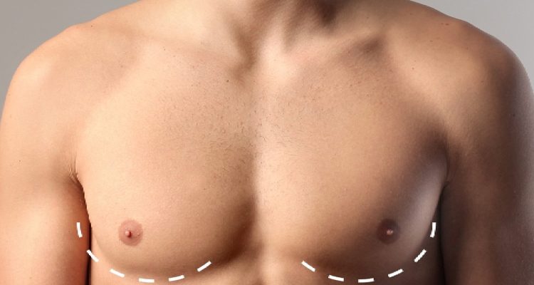 Gynecomastia-banner-blog