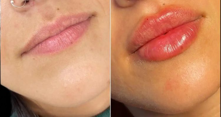 H2-lip-fillers