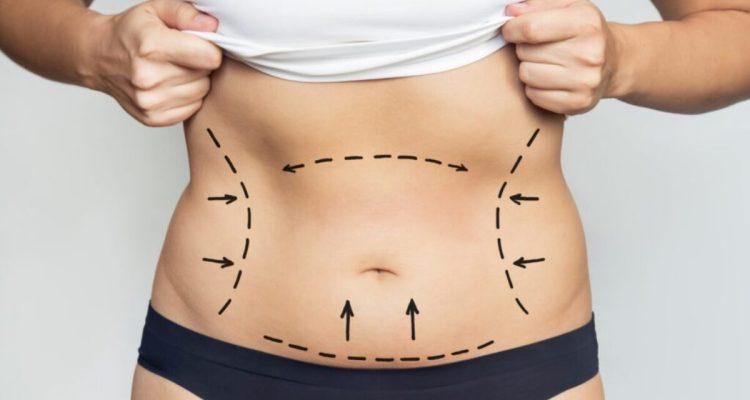 Liposuction Surgery Cost