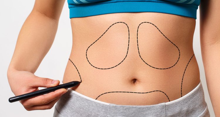 Liposuction surgery in Dubai (10)