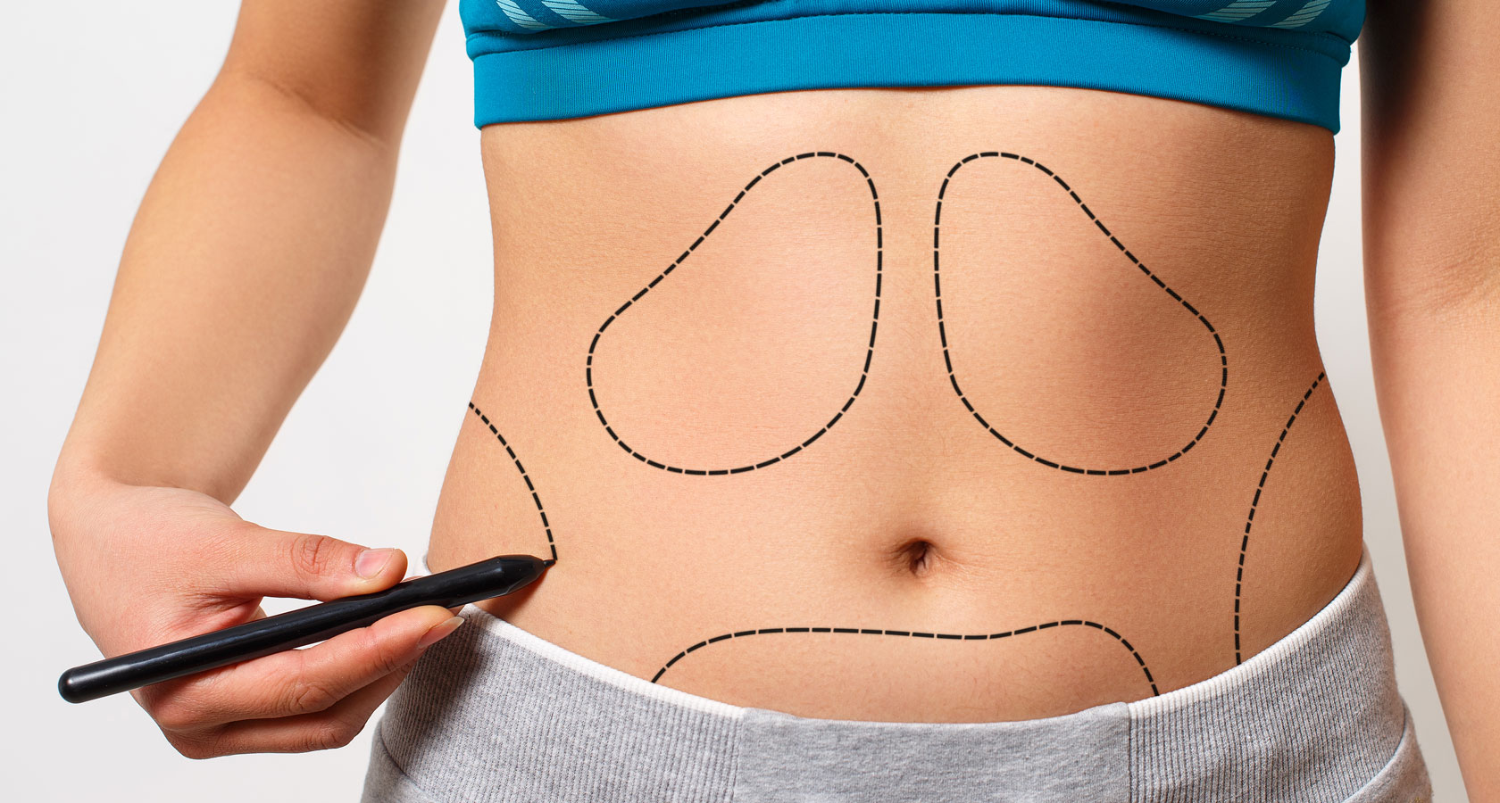 Liposuction surgery in Dubai (10)