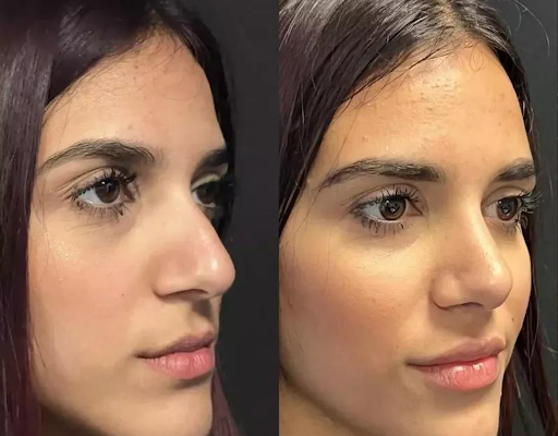 Rhinoplasty in Dubai: Real Patient Stories and Experiences