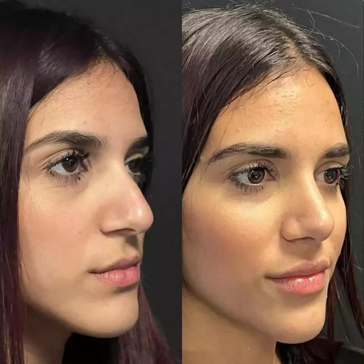 Rhinoplasty in Dubai: Real Patient Stories and Experiences