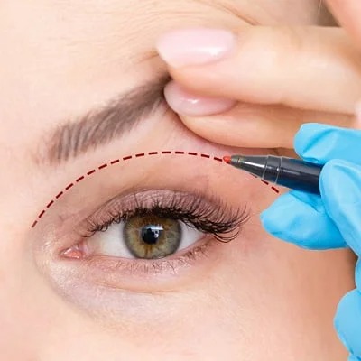 Best Eyelid Surgery in Muscat