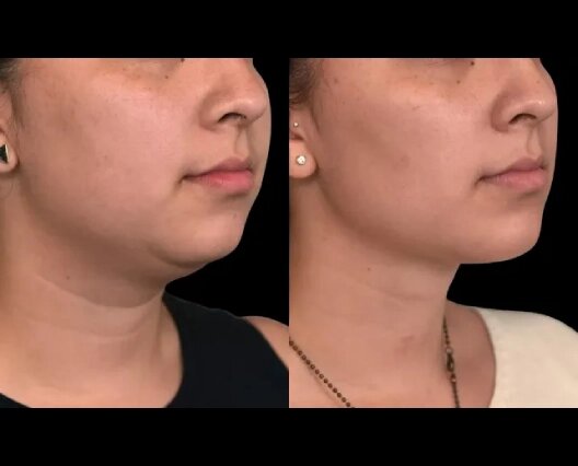 Chin-liposuction-7