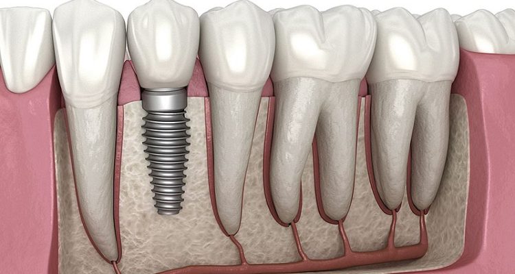 Dental-implant