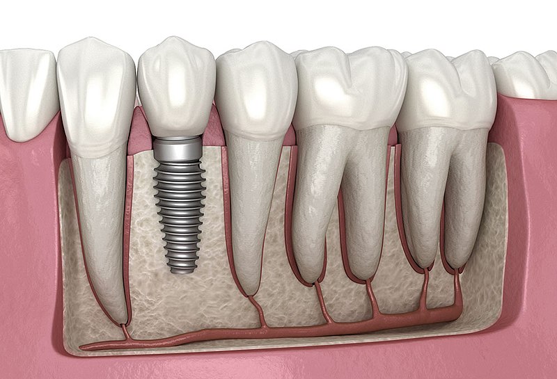 Dental-implant