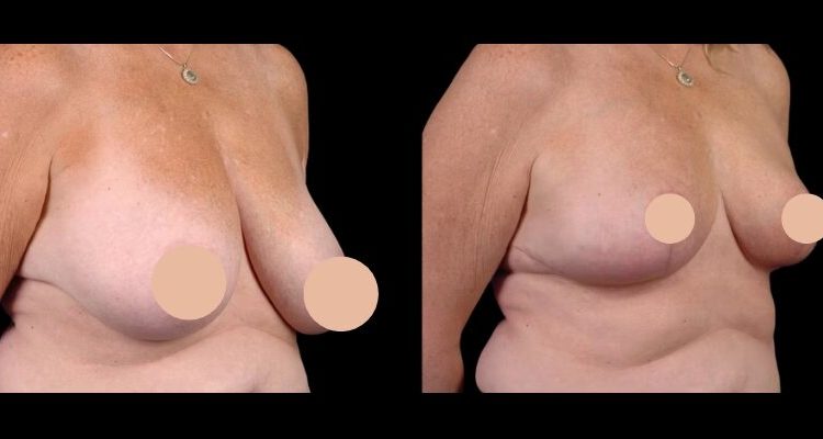 breast reduction in dubai