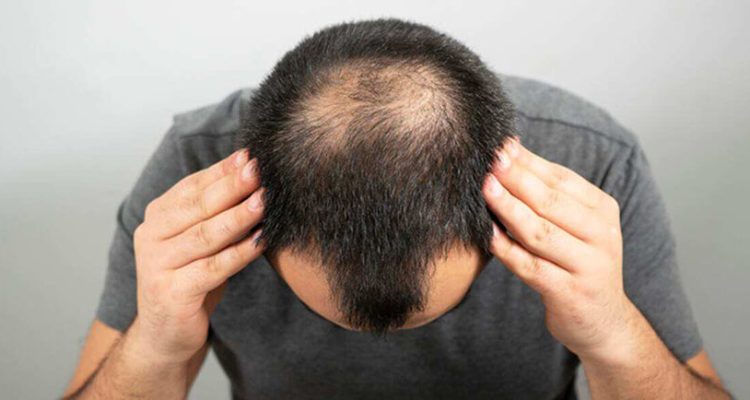 Hair transplant