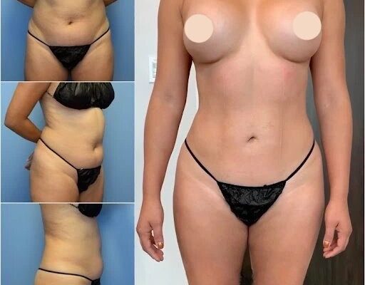 Liposuction-pictures