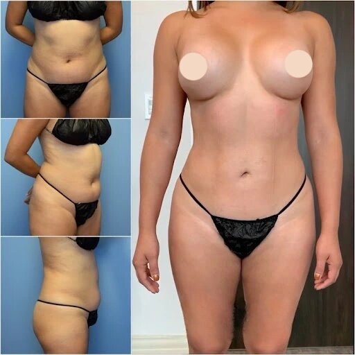 Liposuction-pictures