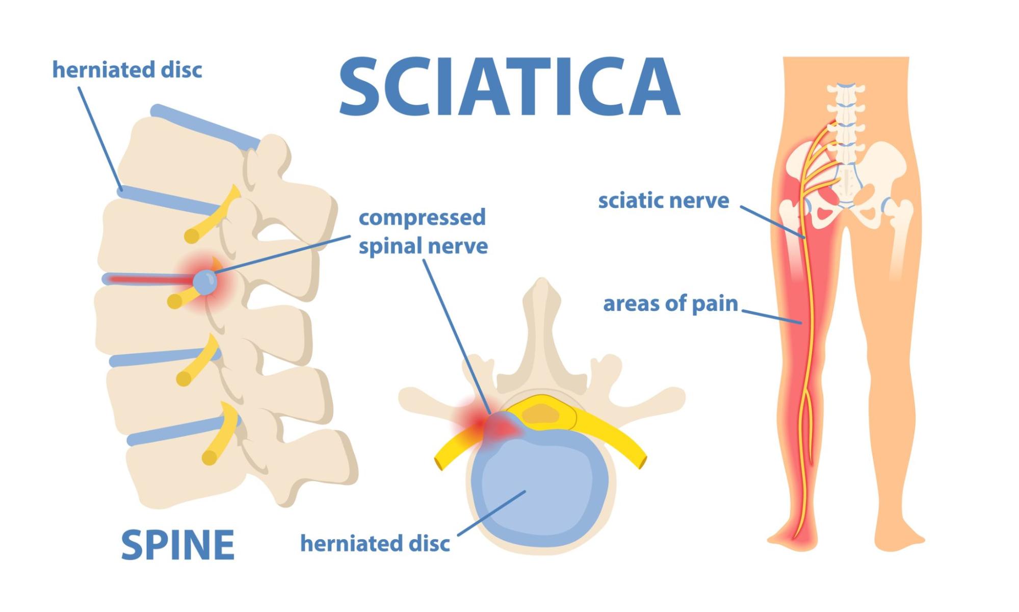 benchmark-physio-sciatica-diagram