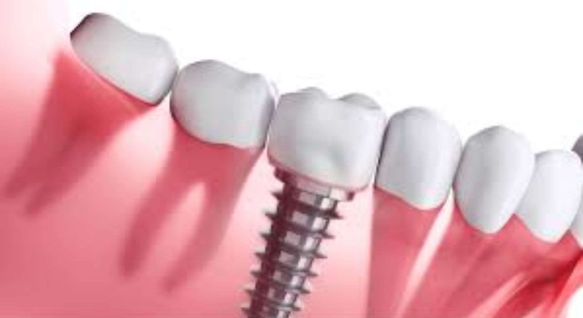 dental implants images