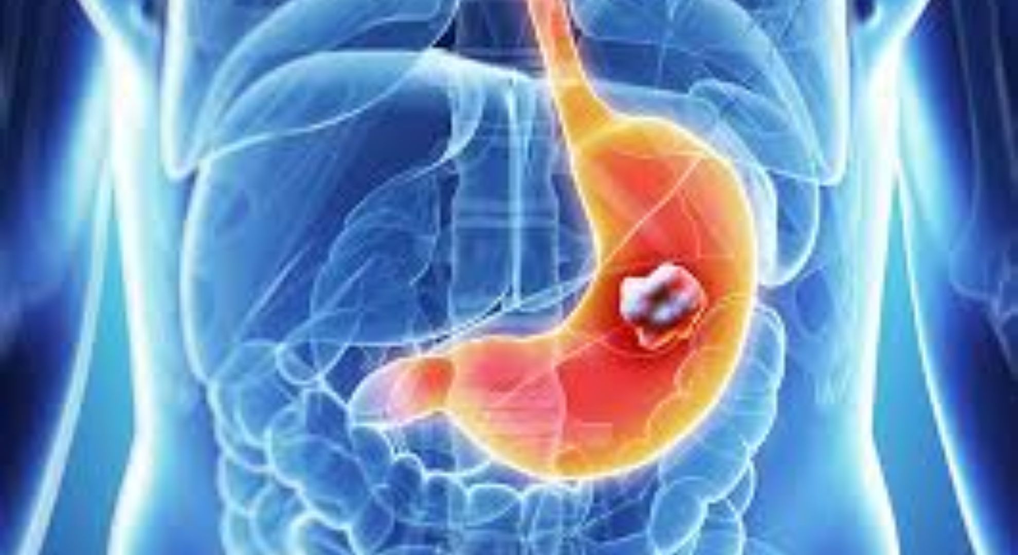 stomach cancer image