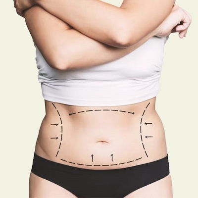 Best Fat Transfer Surgery in Muscat
