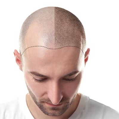 Best Hair Transplant in Muscat