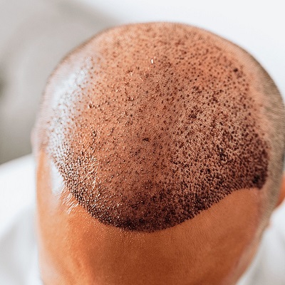 Best Hair Transplant in Oman