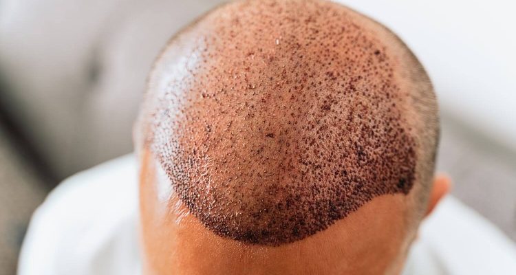 Hair Transplant in Dubai