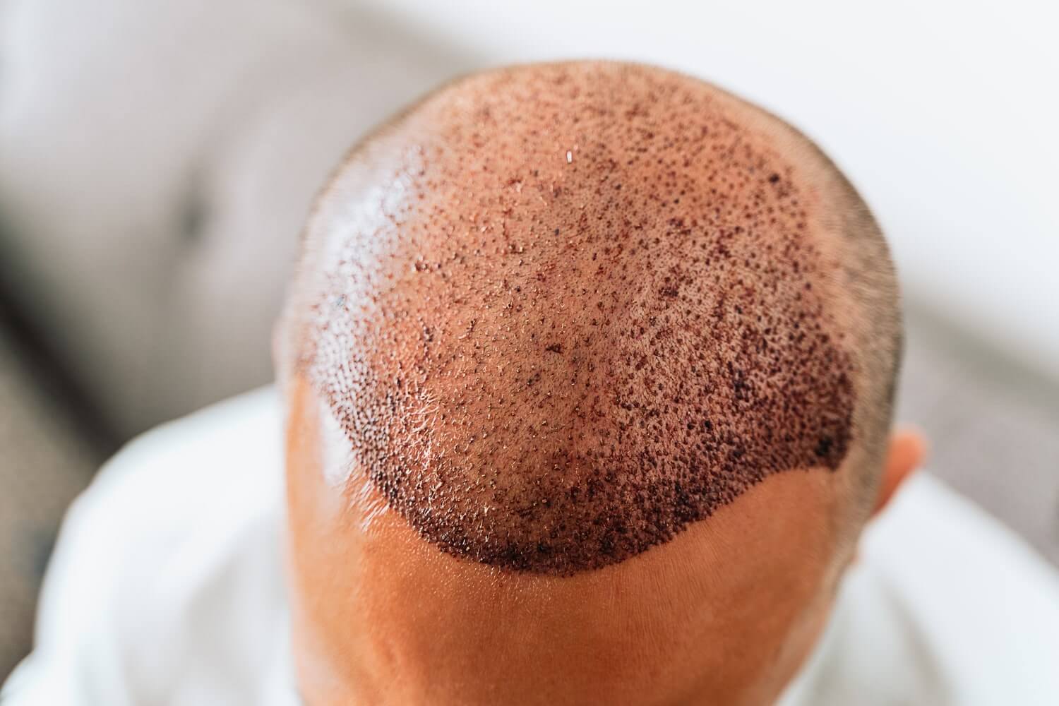 Hair Transplant in Dubai