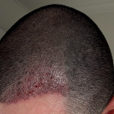 Hair Transplant in Muscat