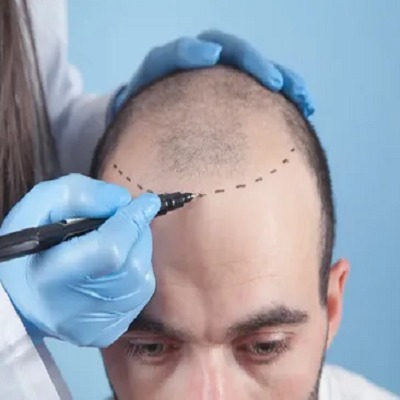 Hair Transplant in Oman