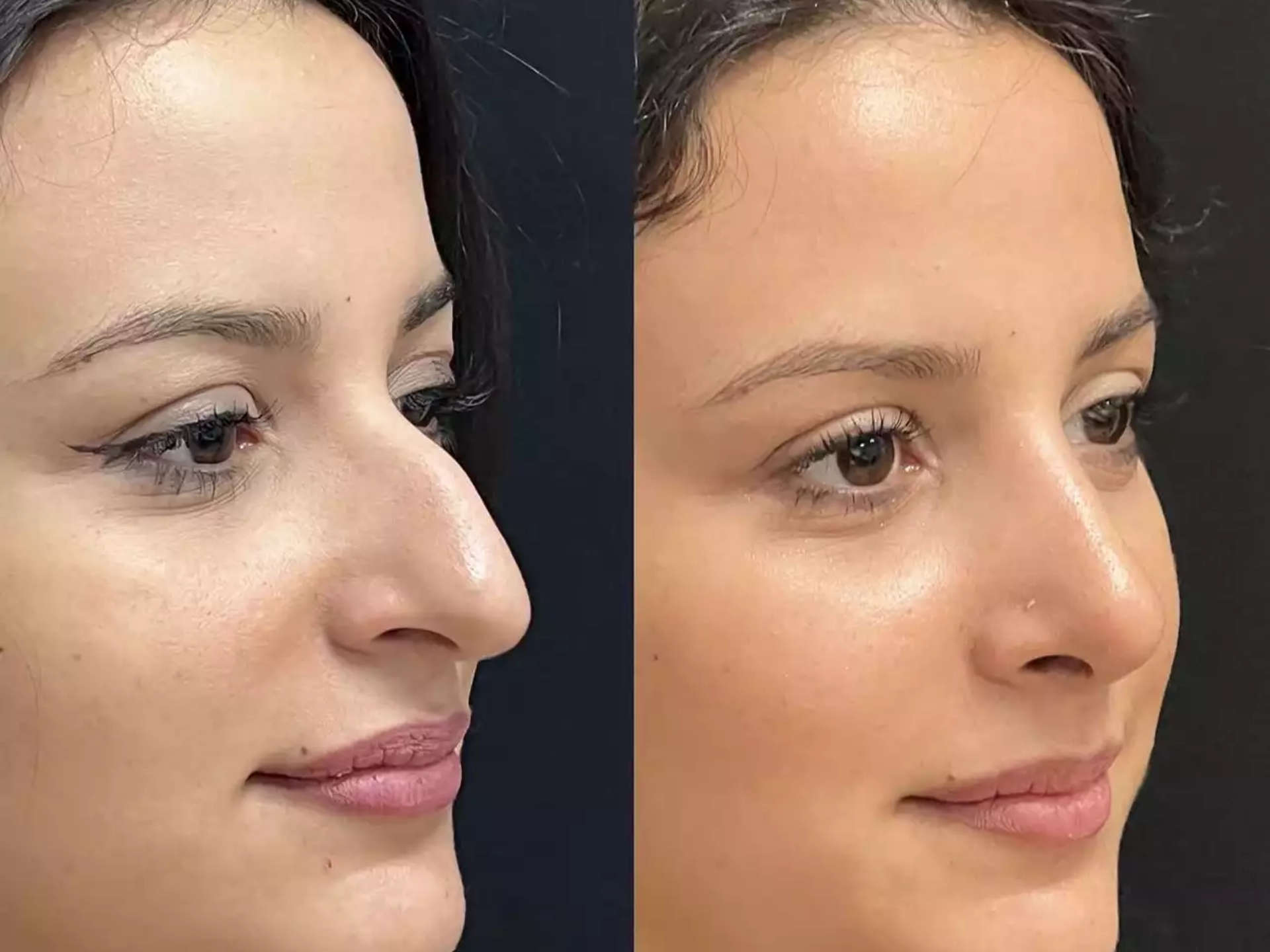 H-Rhinoplasty-10
