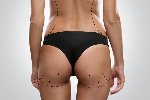 Butt Fat transfer in Dubai