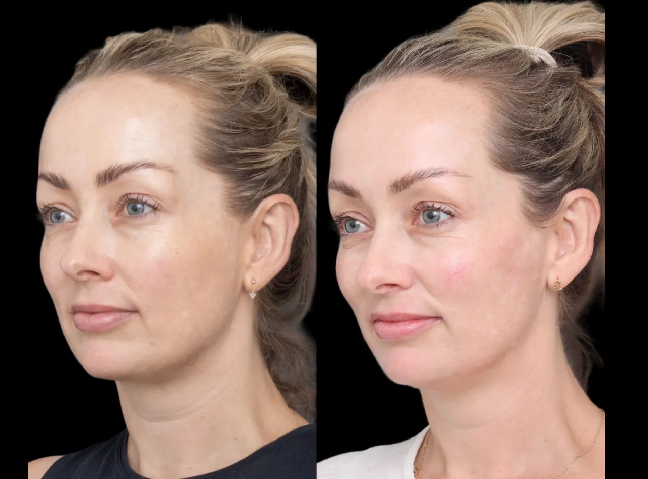 H1-Cheek-Fillers (1)