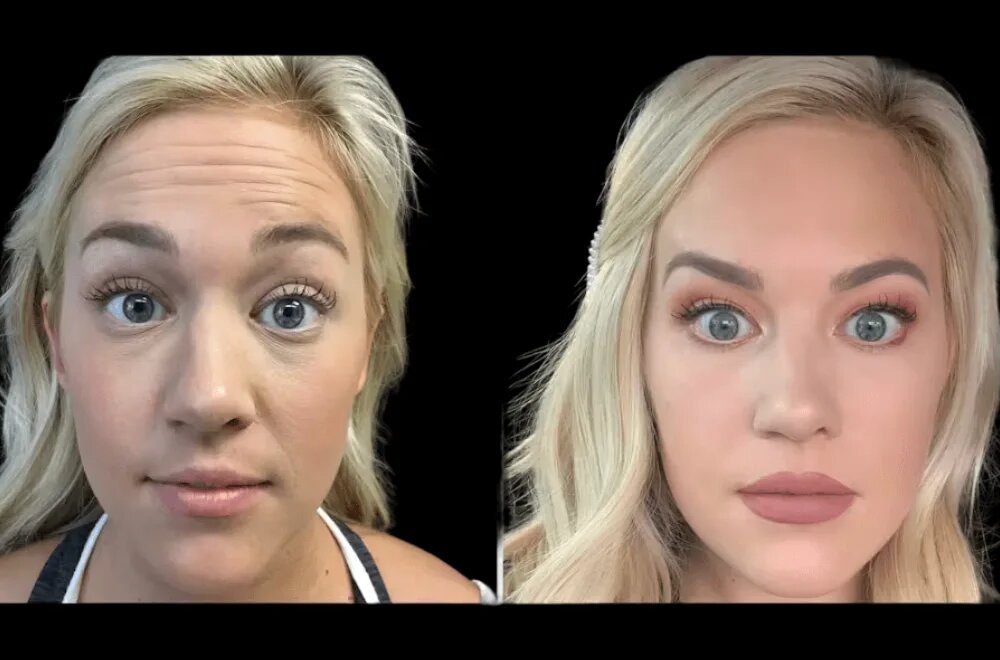 H3-Botox