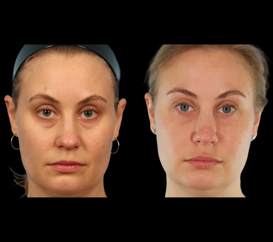 H4-Under-eye-fillers (1)