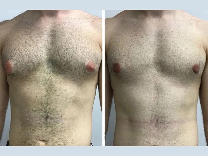 H7-Gynecomastia-ezgif.com-webp-to-jpg-converter
