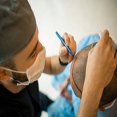 HairTransplant