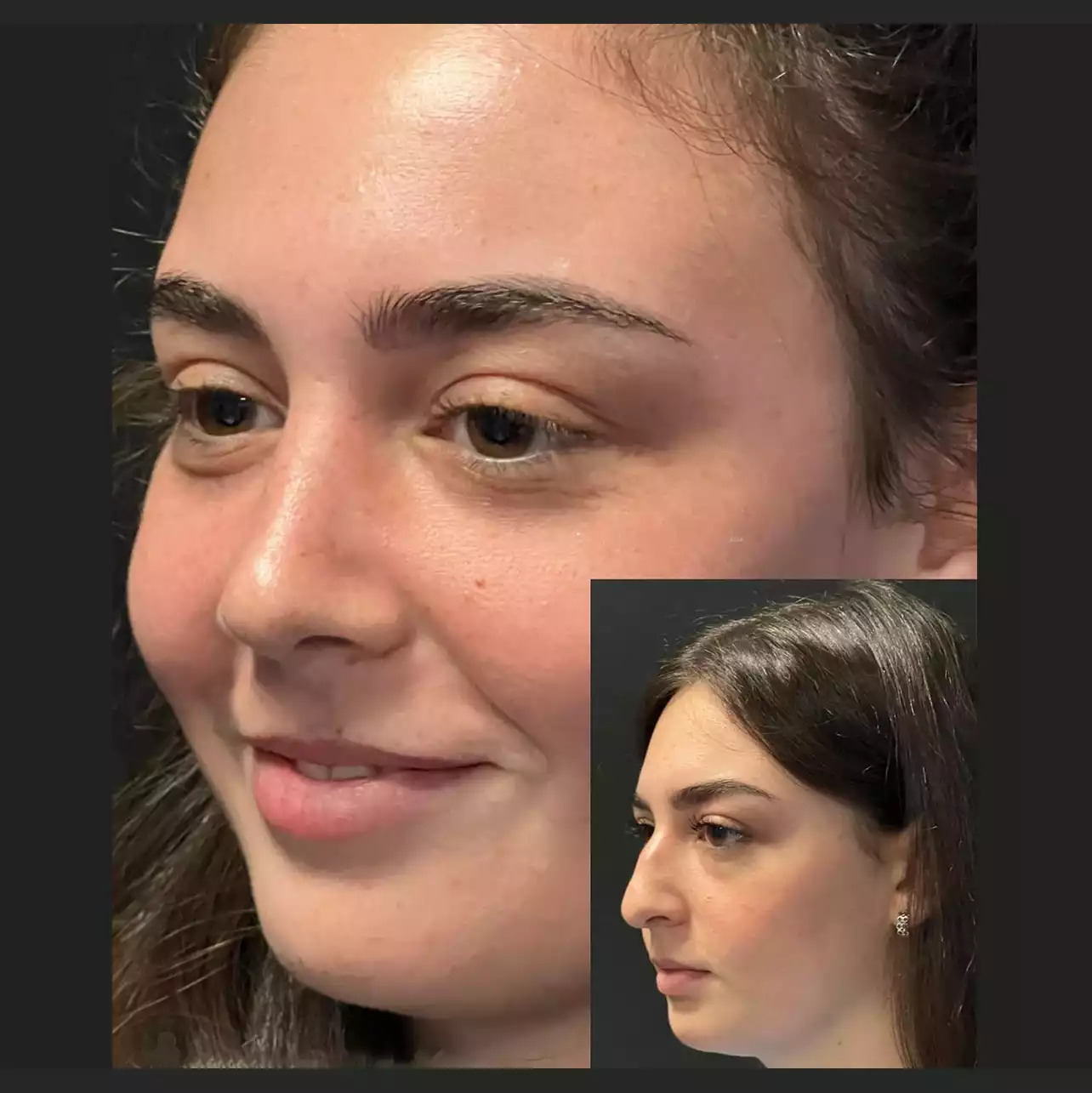 H-Rhinoplasty-12