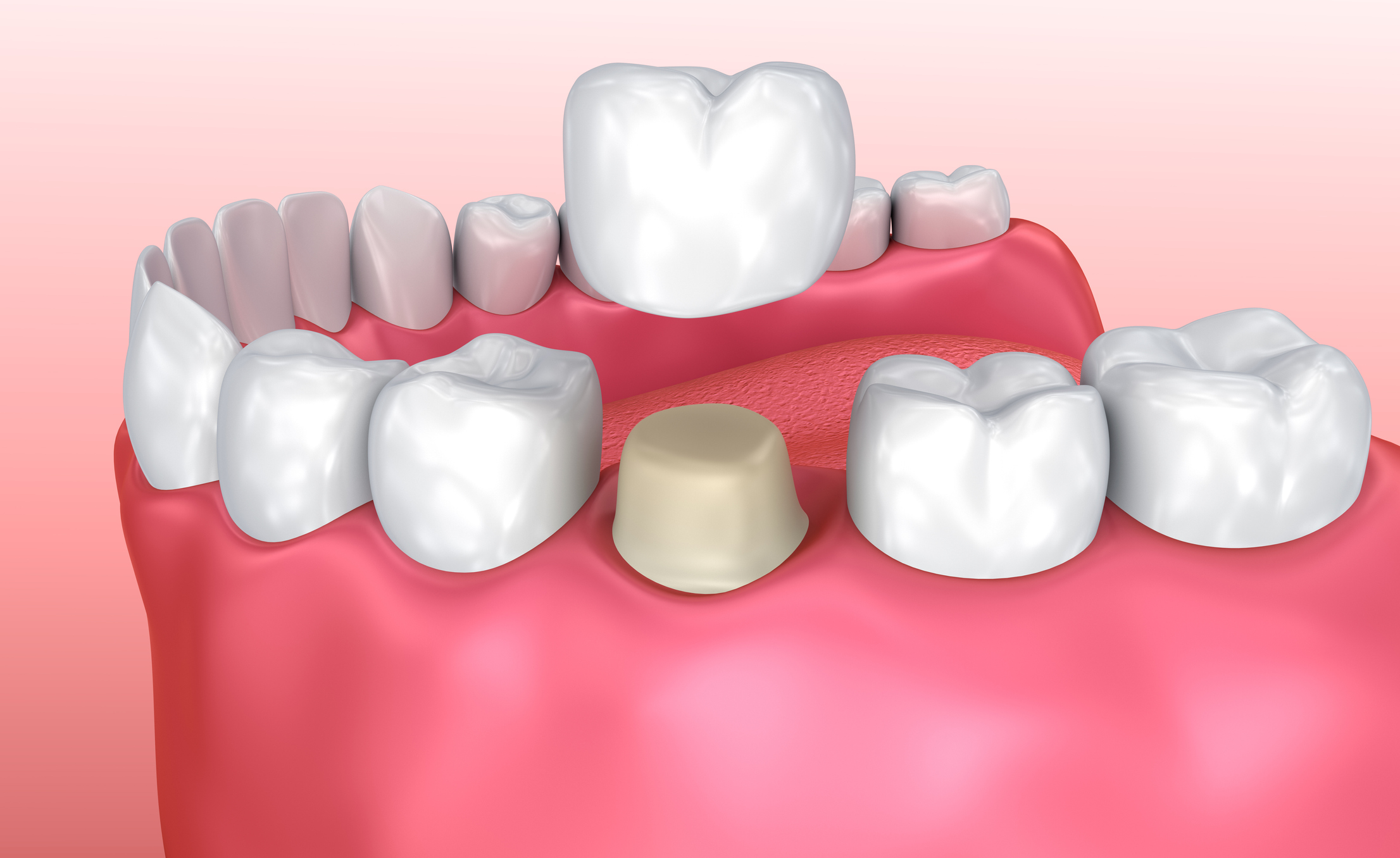 how long do temporary crowns last