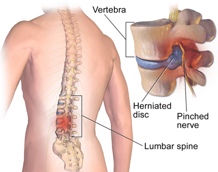 lower-back-pain