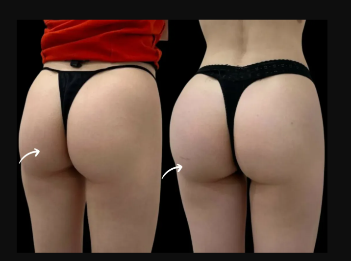 sculptra for hipdips