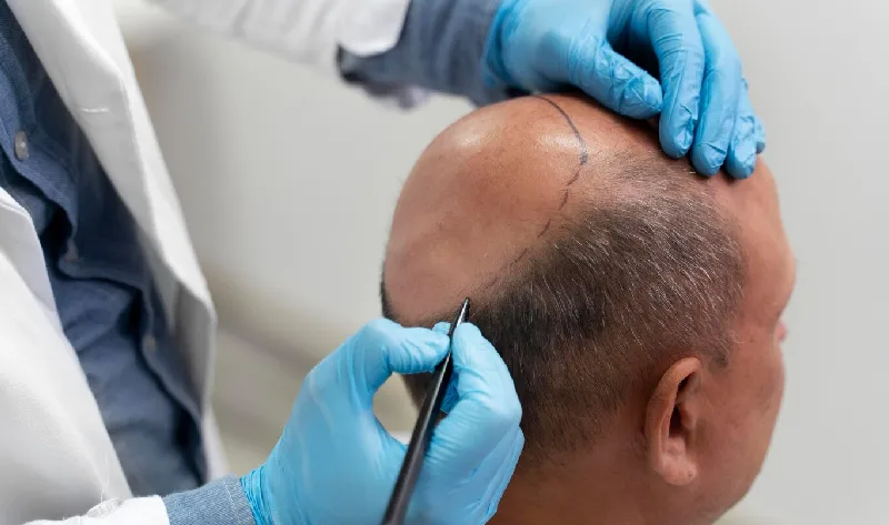 Hair Transplant in Dubai