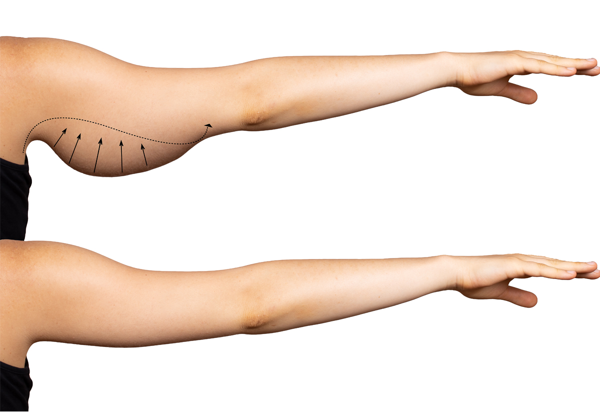 Cost of Arm Lift Surgery in Islamabad