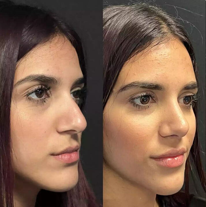 H-Rhinoplasty-11_optimized_150