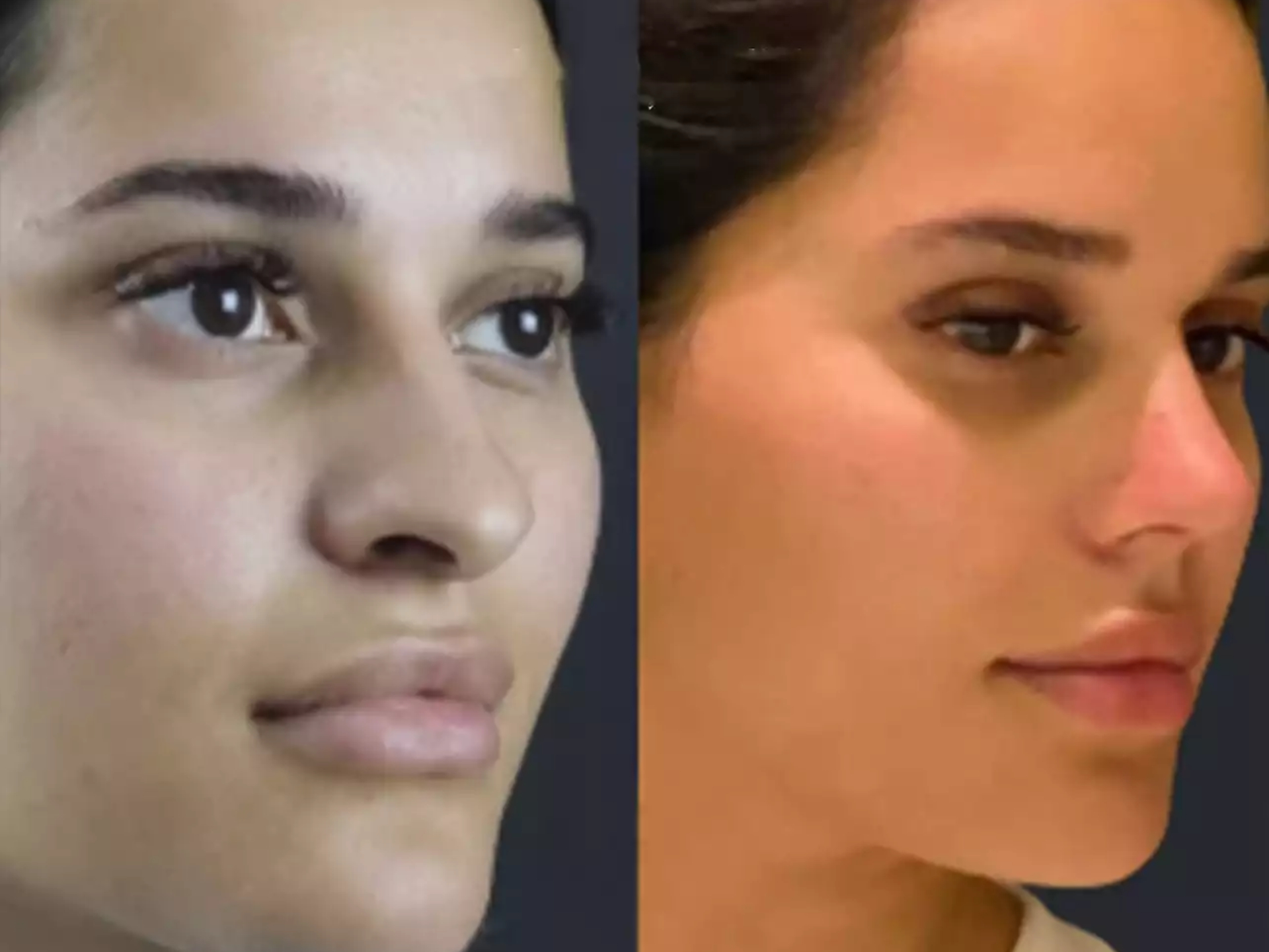 H-Rhinoplasty
