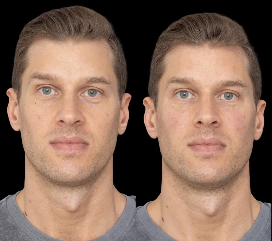 H2-Under-eye-fillers gallery (1)