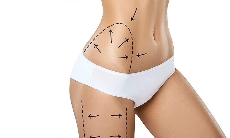 Vaser-Liposuction