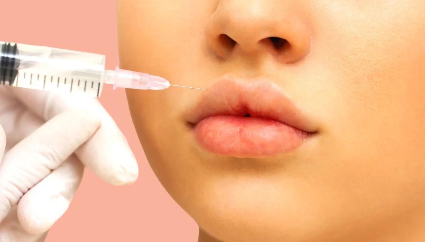 What-is-a-Russian-Lip-Filler