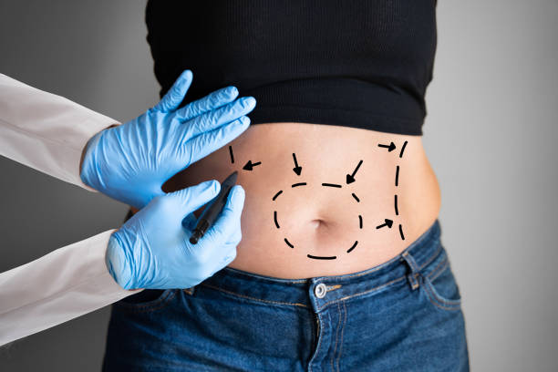 abdominoplasty-obesity-surgery