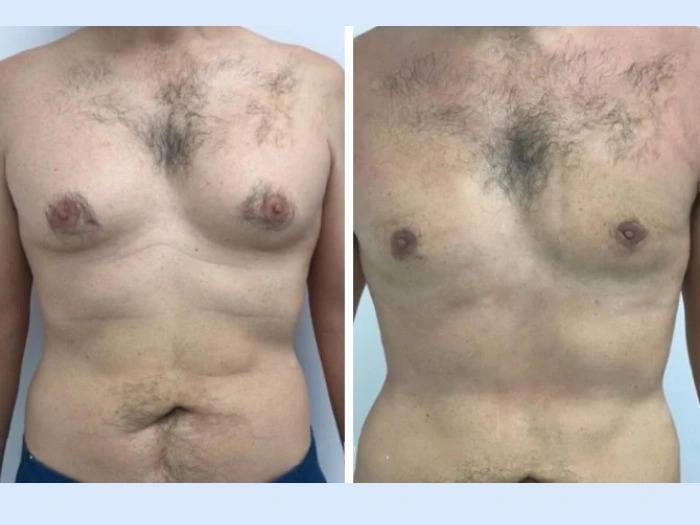gynecomastia in dubai (1) (1)