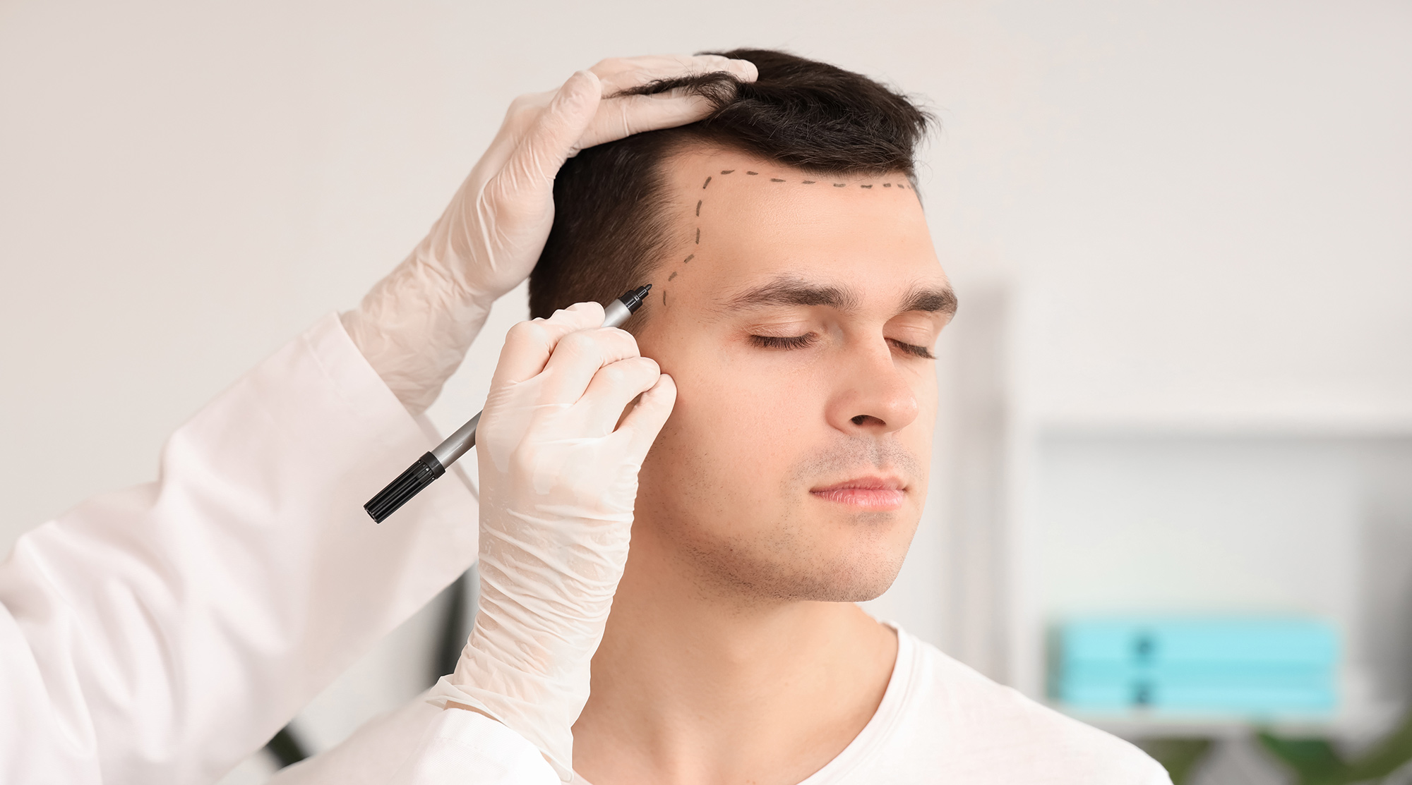 latest-hair-transplant-technology
