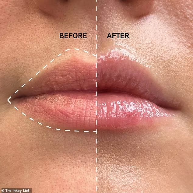lip fillers in islamabad