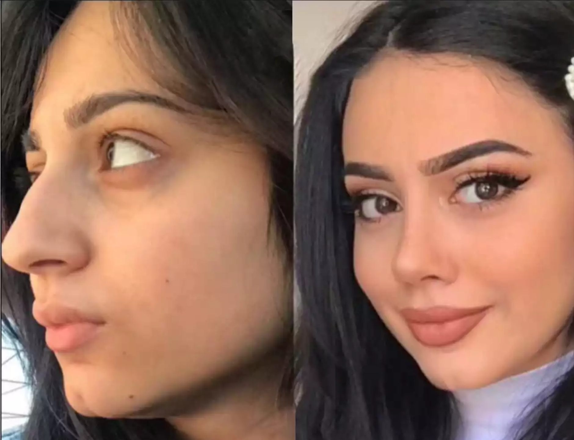 H-Rhinoplasty-6 (1)